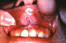 mouthcancer2